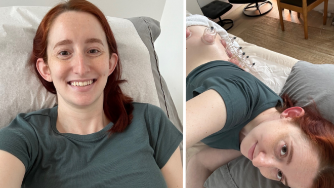 prenatal acupuncture and prenatal cupping